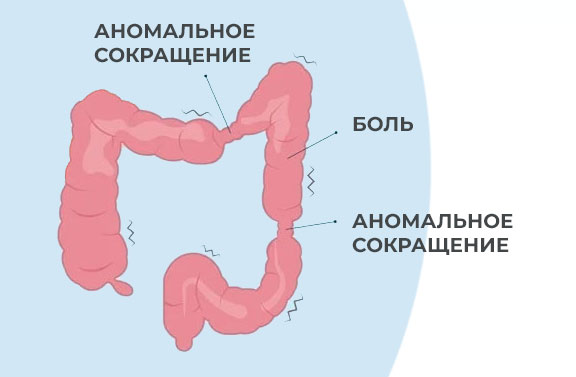симптомы-синдрома-раздраженного-кишечника-срк